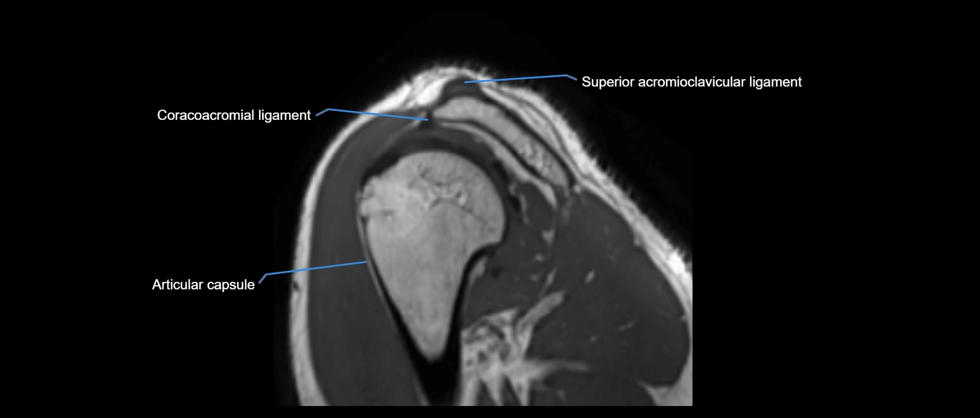 shoulder ligaments sagittal  cross sectional anatomy 3T MRI AI enhanced radiology image -img-00001-00045.webp
